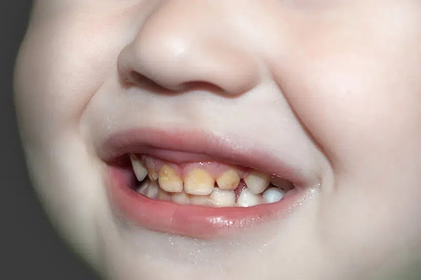 how to prevent calcium buildup on teeth - For Children